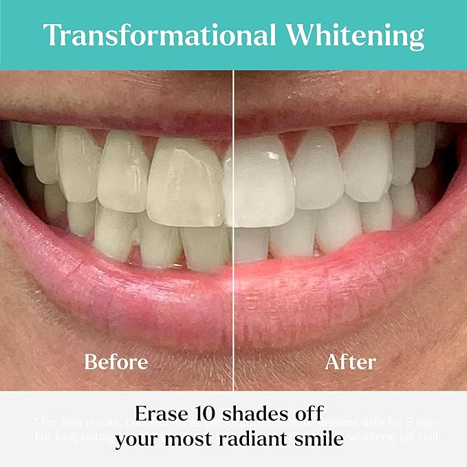 GLO Science So Brilliant Teeth Whitening Kit – Patented Warming Mouthpiece with LED Light Technology, Whitening Gel w/ 6% Hydrogen Peroxide, Lip Balm – Fastest Way to Whiter Teeth, Sensitivity Free